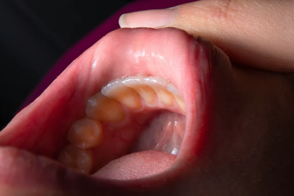 Dementia and Teeth How Grinding Damages the Mouth