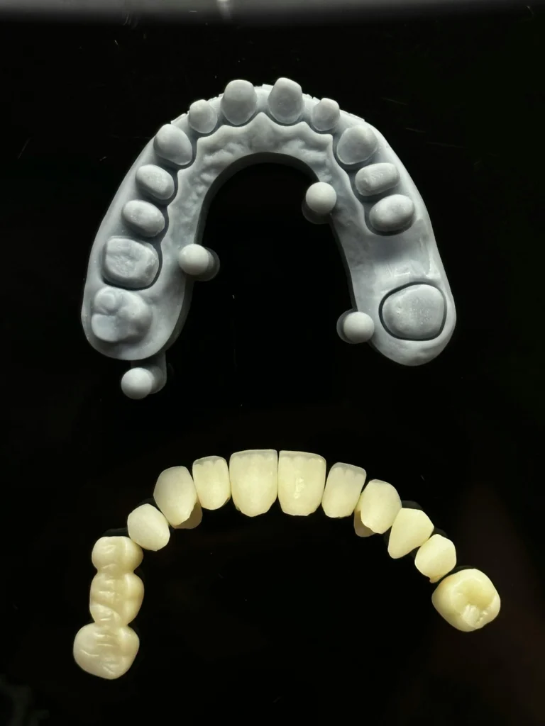 When Denture Glue Isn’t Enough