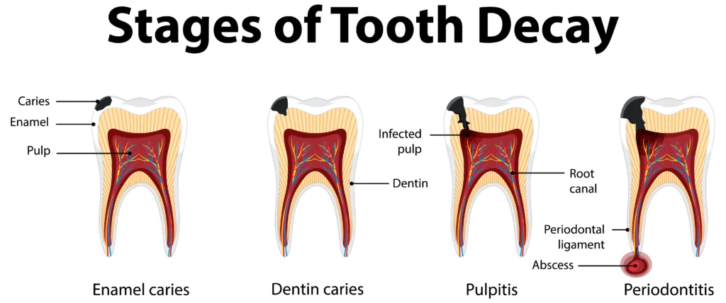 How Quickly Do Cavities Form It Depends on the Stage
