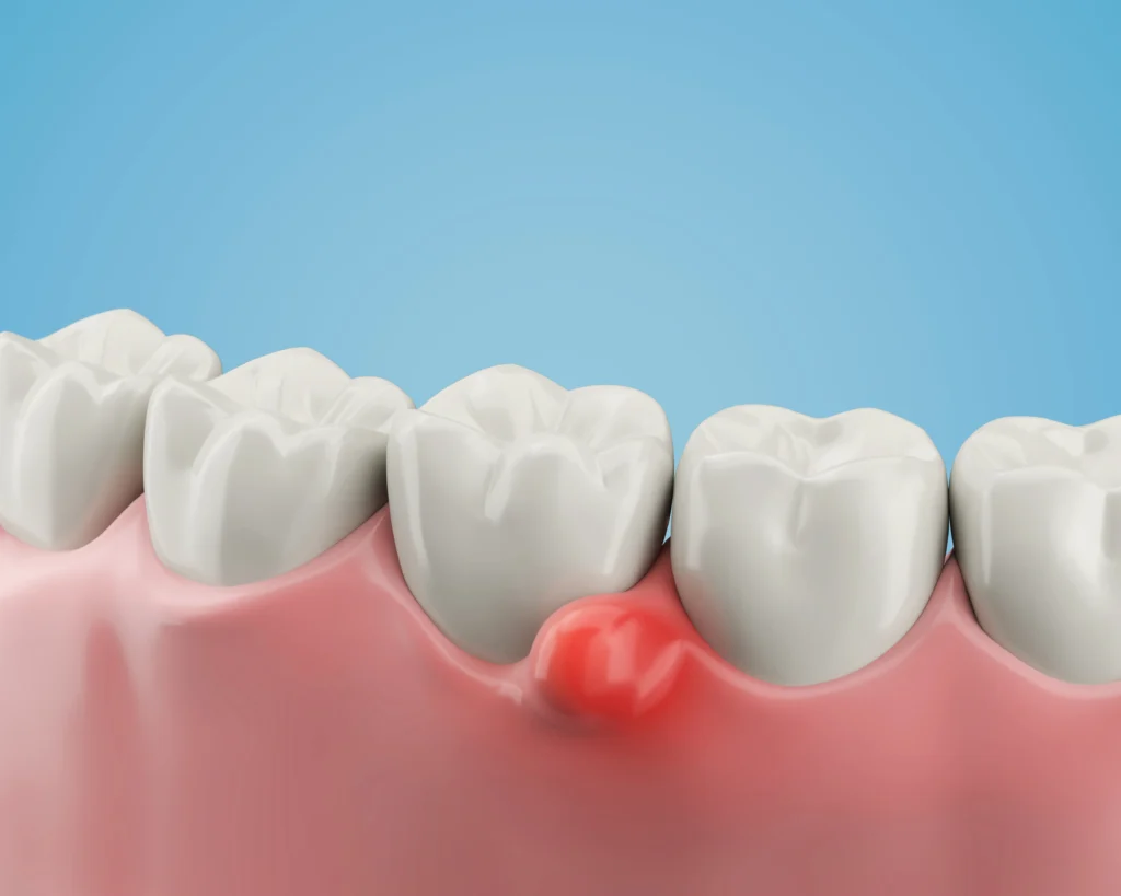 Irritated Gum Around Tooth The Most Common “Everyday” Triggers