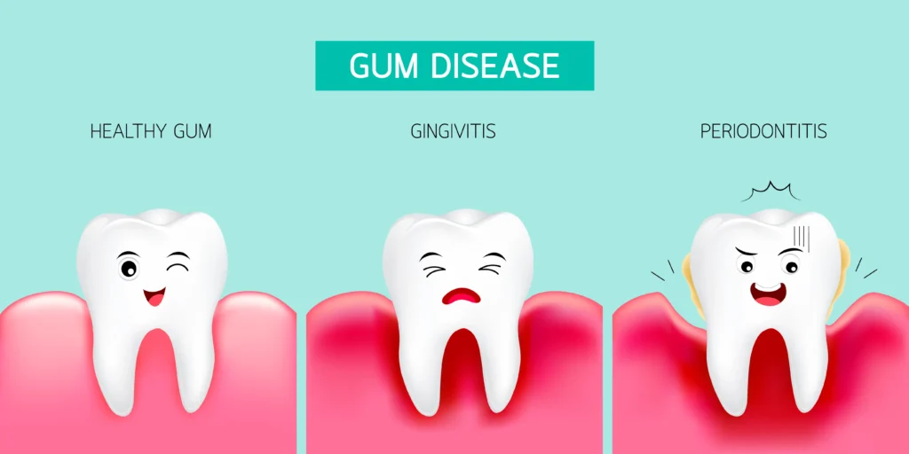Gum Disease Early Signs What to Watch For at Home
