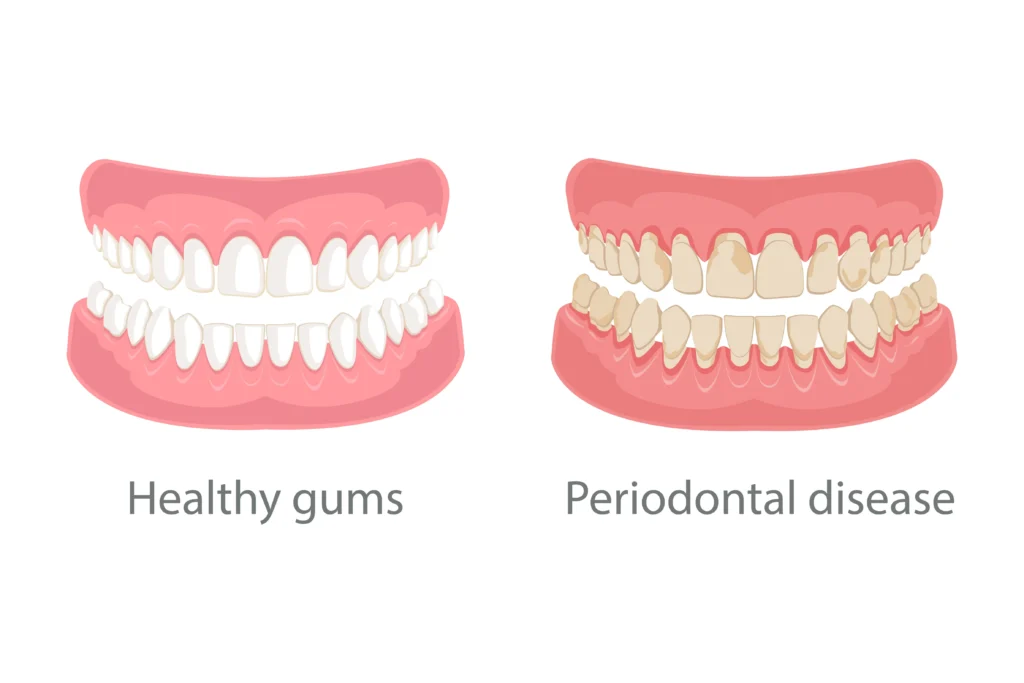 How to Improve Gum Health Quickly With In-Home Dental Support