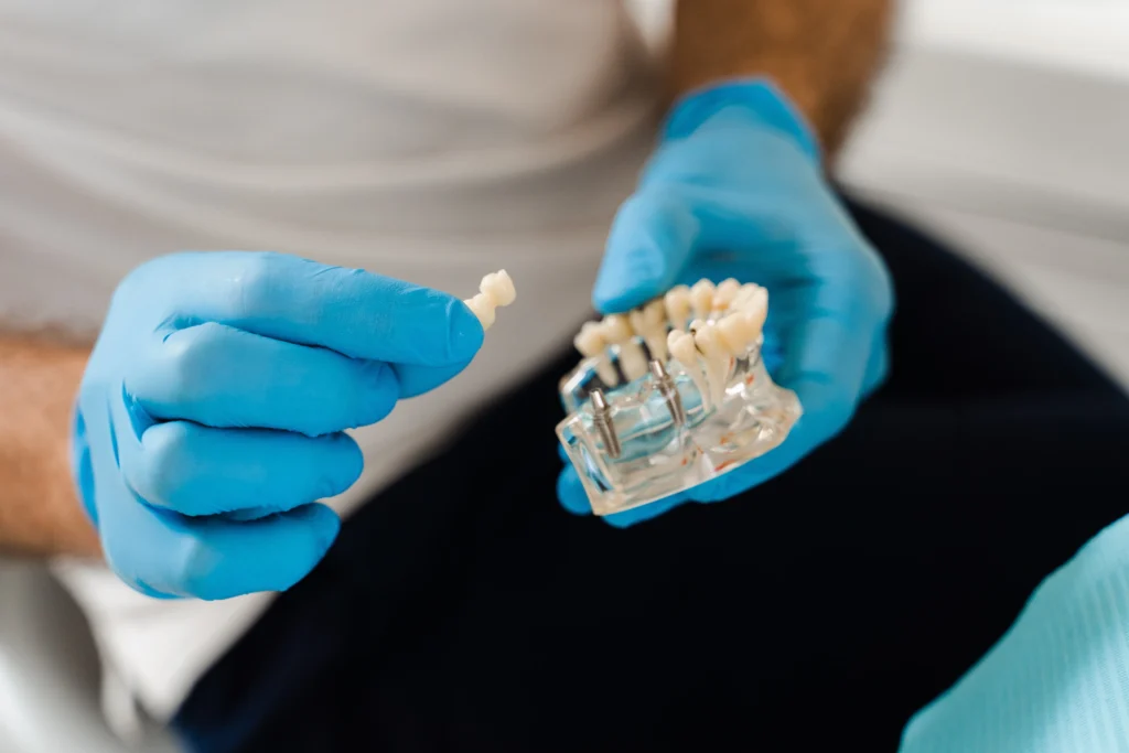 Dental Implants Surgery Recovery The First 72 Hours That Set the Tone