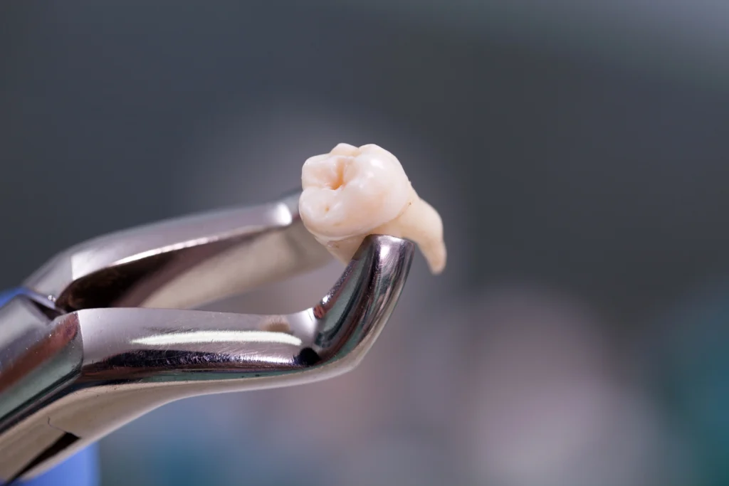 Emergency Tooth Extraction at Home Is Not the Same as DIY Removal