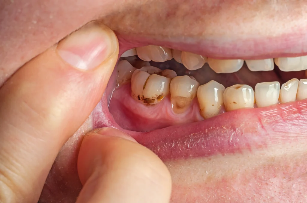 When a Loose Tooth Is Tied to Decay or Structural Damage